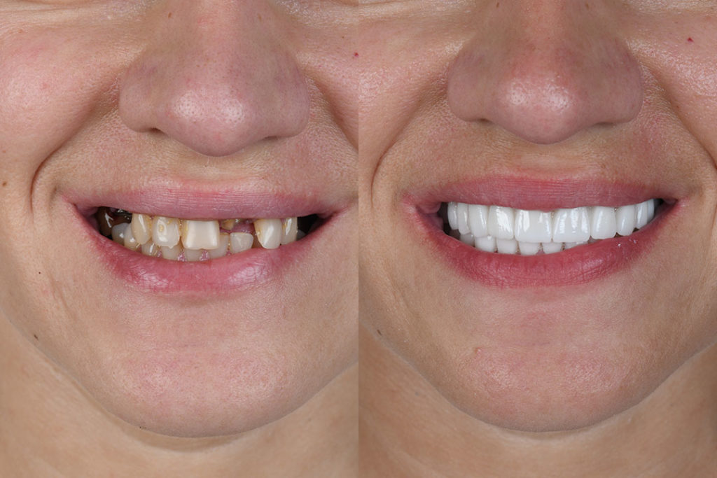 replacing damaged teeth