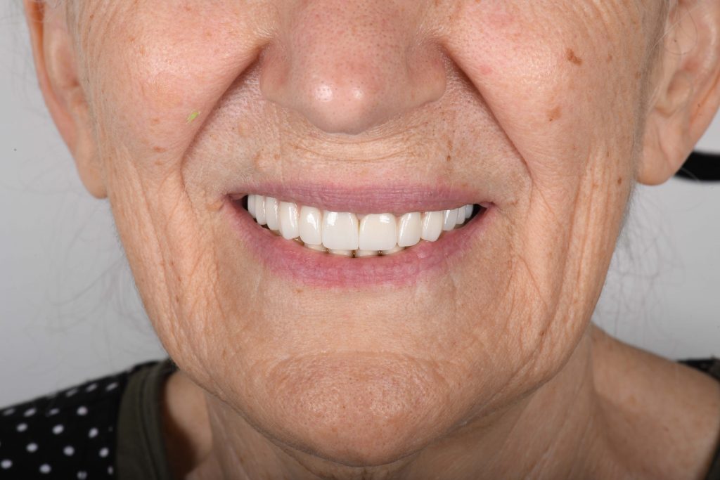 a lady who have done zygomatic implants